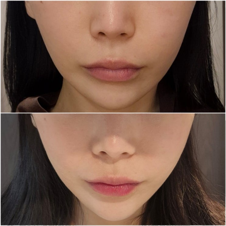  티타늄리프팅 튠라이너 꼼꼼한 시술, 티타이너 리얼 후기