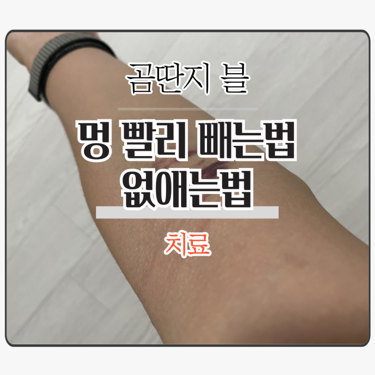  멍 빨리 빼는법 및 치료 '없애는법'