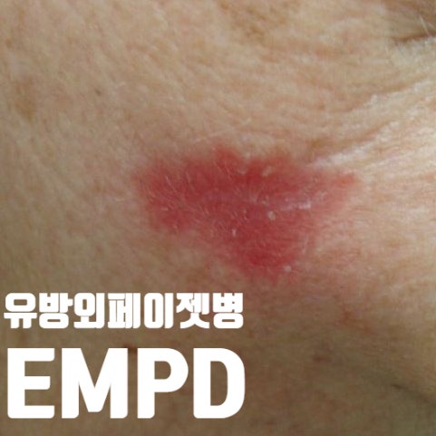  붉기만 한데, 악성종양이라고? 유방외페이젯병(Extramammarian Paget'disease; EMPD)