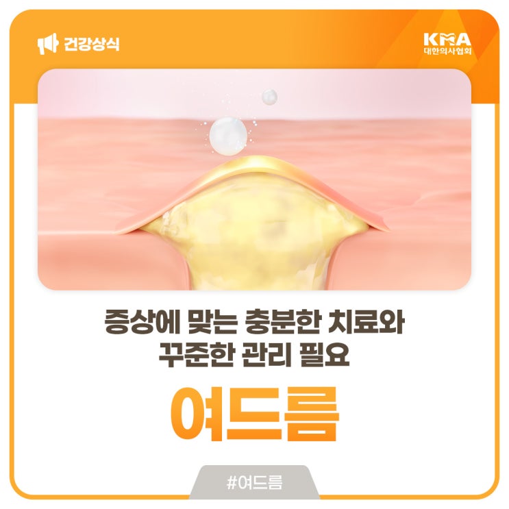  여드름, 증상에 맞는 충분한 치료와 꾸준한 관리 필요