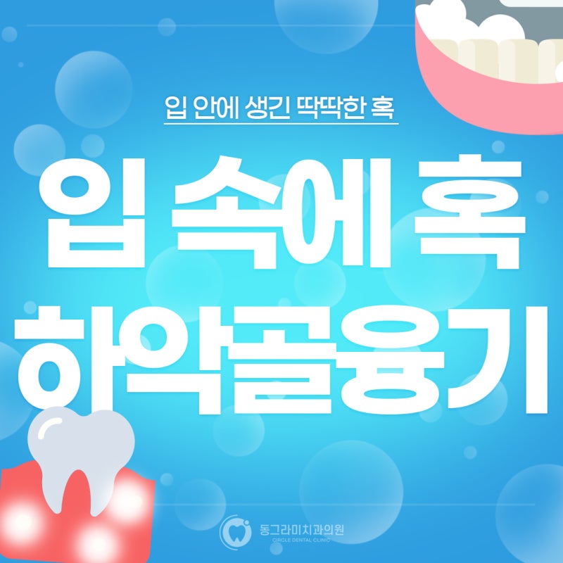 [화정치과] 입 속에 혹 하악골융기, 방치하면? (하악골융기 잇몸뼈증식 혀밑에딱딱 입안의혹 ....