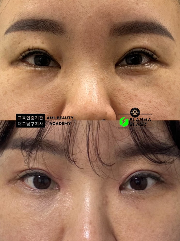  수술없는 플라즈마 상안검 쌍꺼풀 교정 쳐진눈 부작용없이 예쁜 눈매 교정!플라즈마수강 최다임상 아미뷰티아카데미