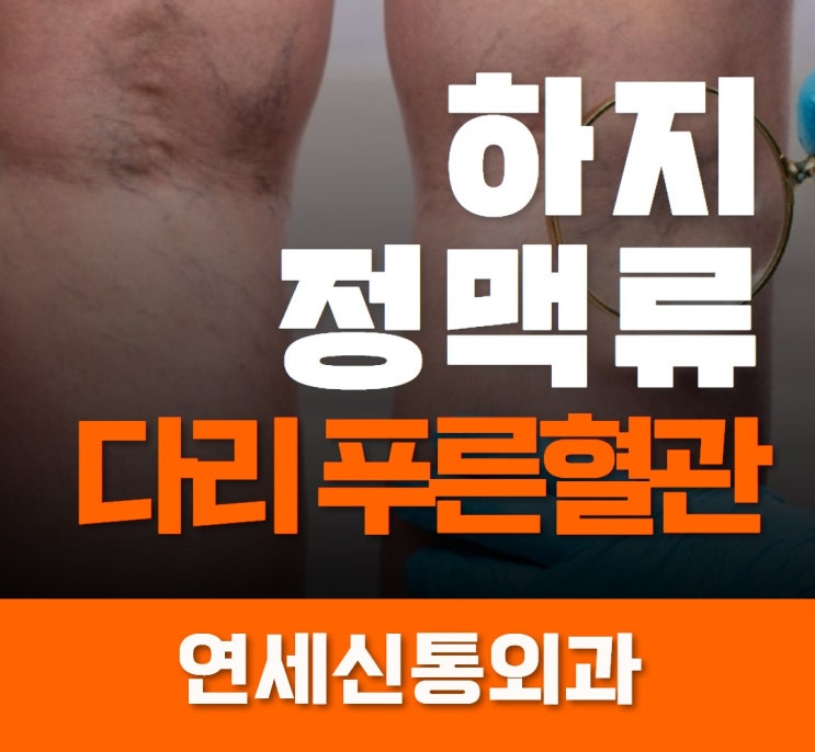 범계 하지정맥류 다리에 푸른혈관 드러나면