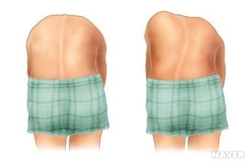 The cause and symptoms of scoliosis? — 본문 그림