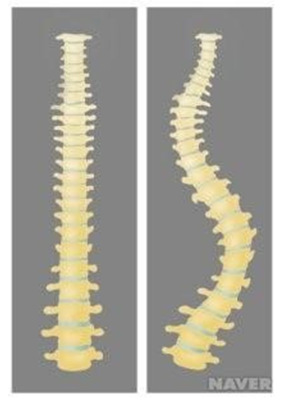 The cause and symptoms of scoliosis? — 본문 그림