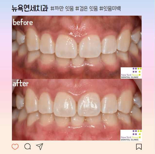 잇몸이 까매요 검은색 까만 잇몸 미백으로 해결
