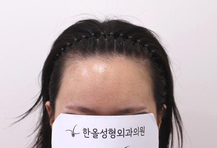  30대 여성 헤어라인 교정 비절개 3500모 2주 경과