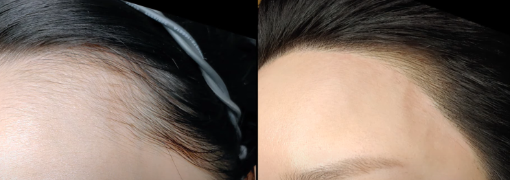  여성 헤어라인 문신 총정리 (반영구, 두피문, 주의할 점 등)
