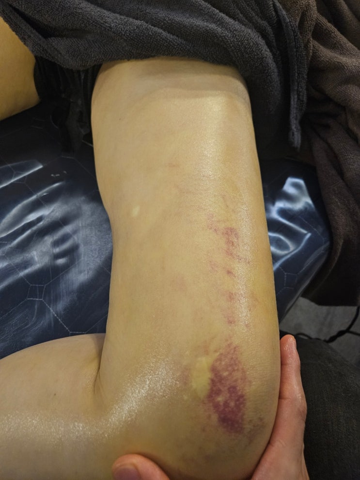  허엉무 지방흡입 통증 한 쪽 다리만 붓는 것 같은 이유
