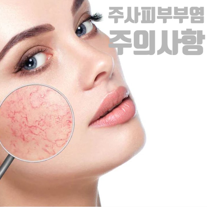  주사(Rosacea)환자들이 지켜야 할 생활습관