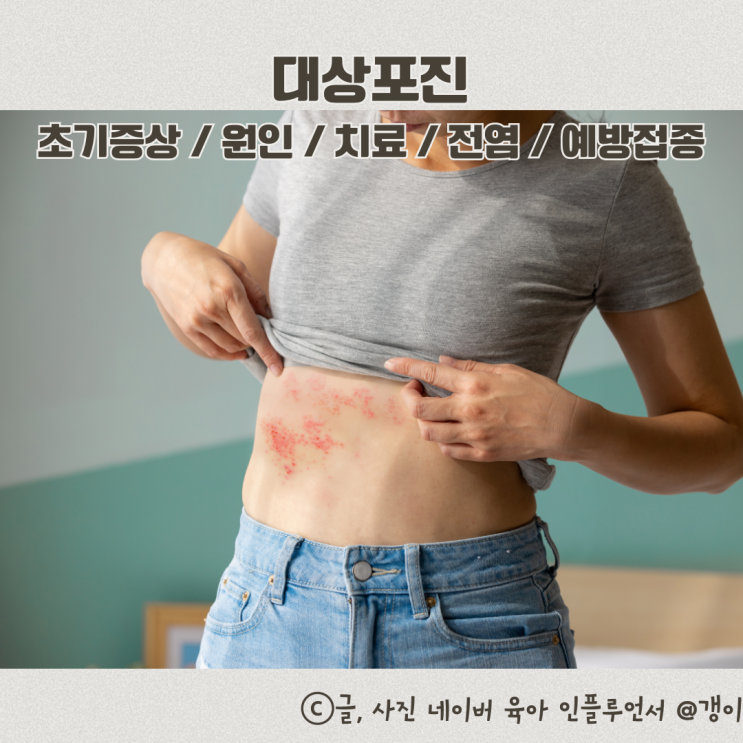  대상포진 초기증상 원인 예방접종