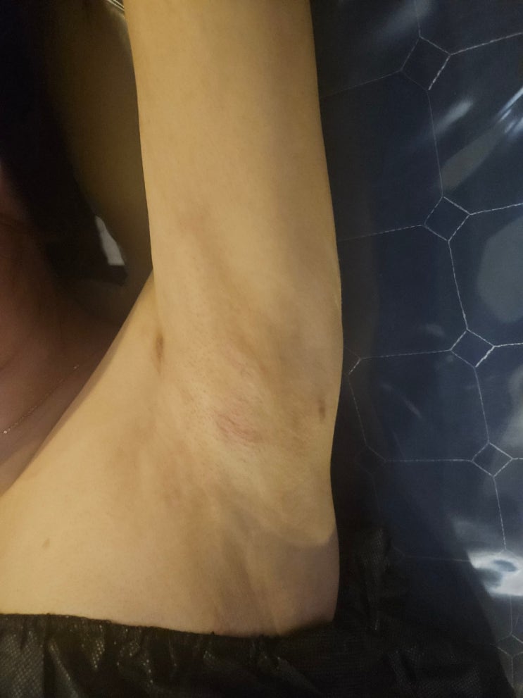  팔 지방흡입 후관리 목 어깨가 불편하실 경우 이렇게 해보세요.
