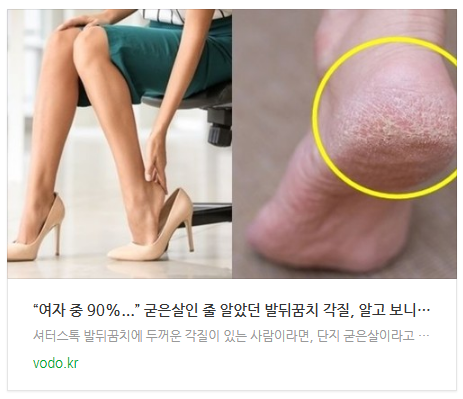 [뉴스] “여자 중 90%...” 굳은살인 줄 알았던 발뒤꿈치 각질, 알고 보니 '이것'