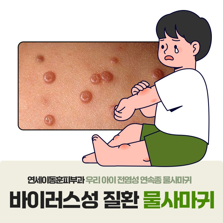[연세이동훈피부과] 아이 몸에 난 물사마귀, 어떻게 치료해야 하나요?