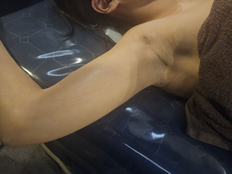  팔뚝 지방흡입 유착으로 팔이 안 올라갈 때 꼭 풀어주셔야 하는 곳은?