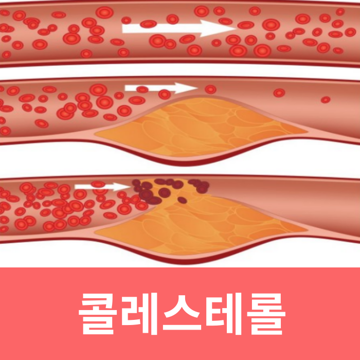  총 콜레스테롤 낮추는 음식 수치 식단 방법 (LDL, HDL)