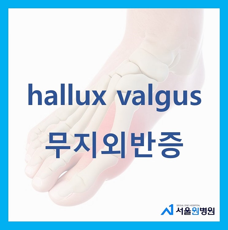  강서구정형외과 엄지발가락 통증원인 무지외반증 치료와 예방은 서울원병원