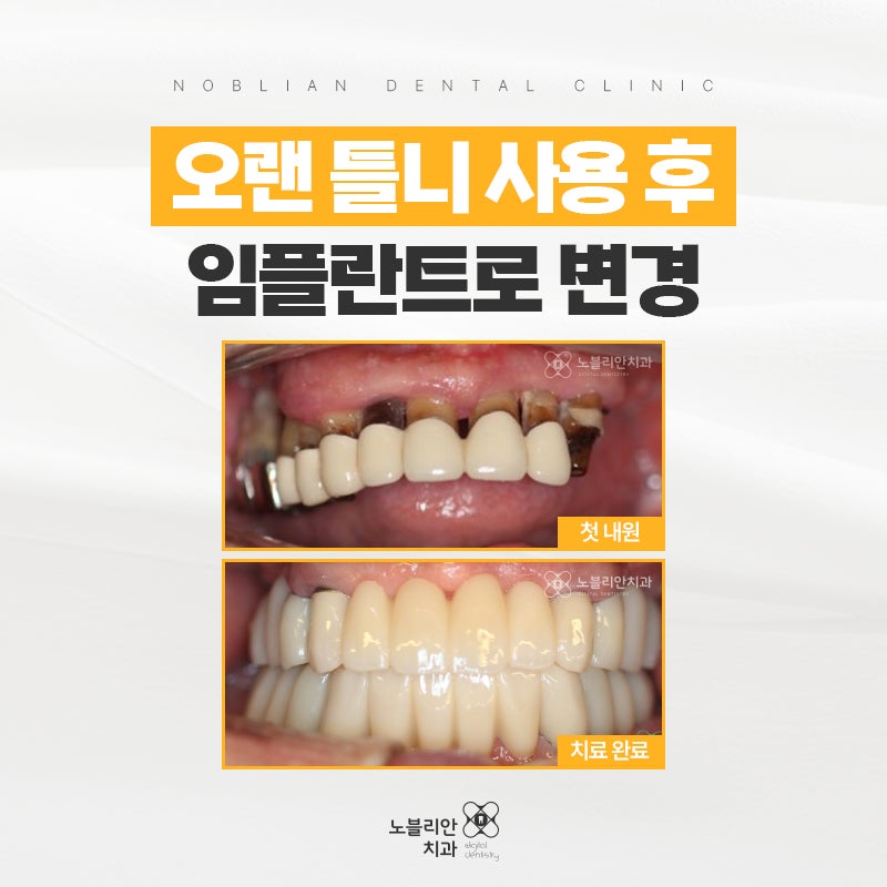 익산 임플란트 치료기간을 놓치지 마세요.