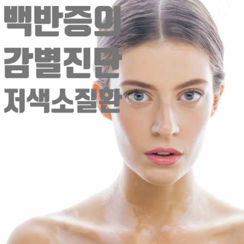  몸에 하얀 반점이 있을 때, 모두 백반증은 아니에요! (감별진단)