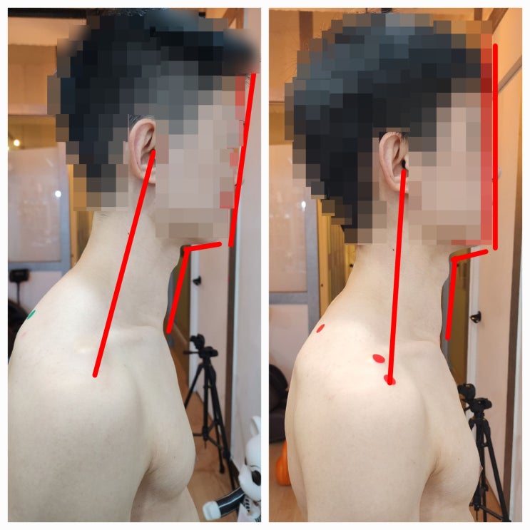  어깨통증으로 내방해주신 회원님 일자목교정 비포에프터 후기