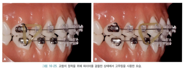  교정할 때 삼각형 고무줄은 왜 거는걸까요?