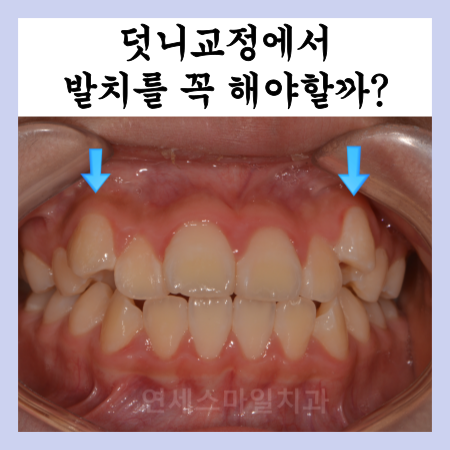  덧니교정에서 '이것'을 놓치면 안됩니다. (노원구교정치과)