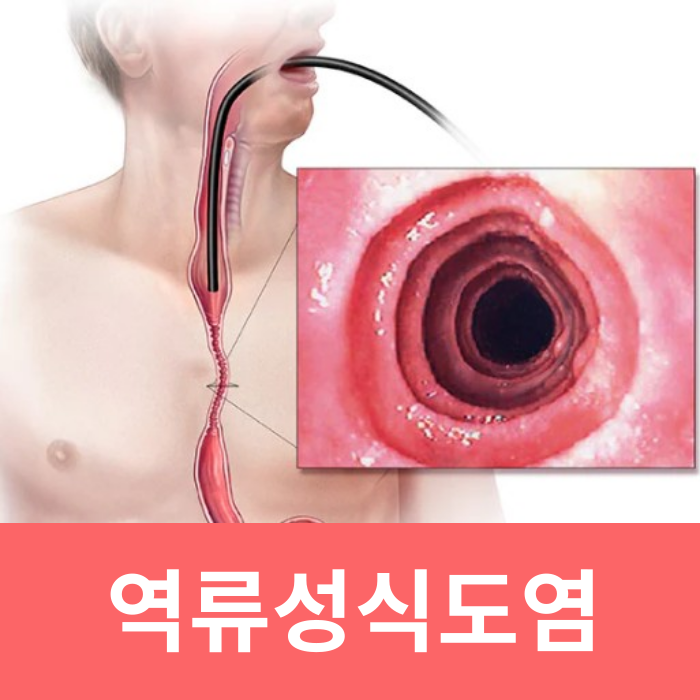  역류성식도염 등통증 원인 증상 운동 좋은음식