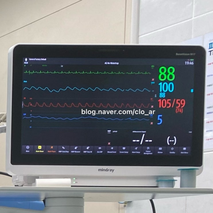 마취&회복 / Patient monitoring : BP(sbp, dbp, mbp, nibp, abp, zeroing)