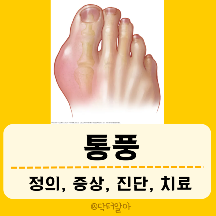  통풍(Gout)의 정의, 증상, 진단 및 치료