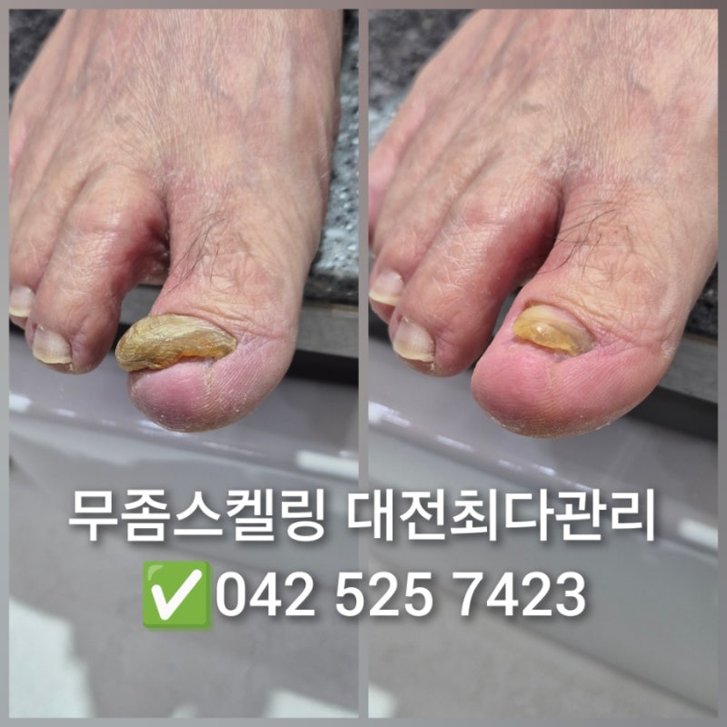 대전 무좀발톱병원 찾다가 무좀발톱관리전문 대전최다관리 뮬랑네일더뷰티에서 무좀스켈링....