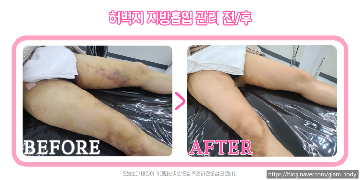  허벅지 지방흡입 붓기,멍 고주파관리 후기