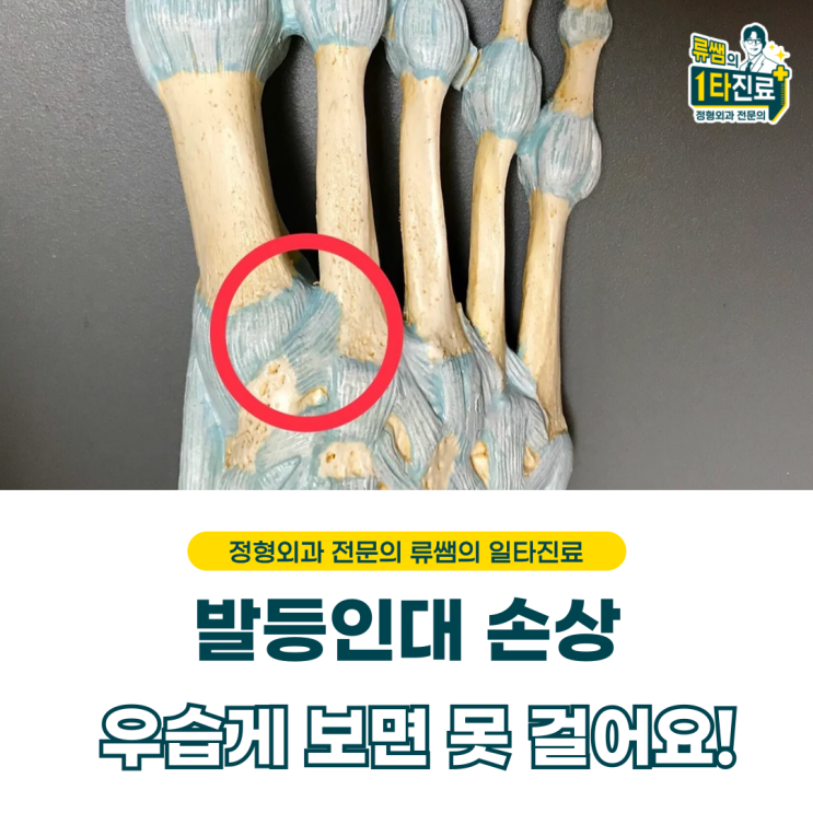  축구하다가 다친 발등인대 , 리스프랑인대 수술 치료  (의사작성)