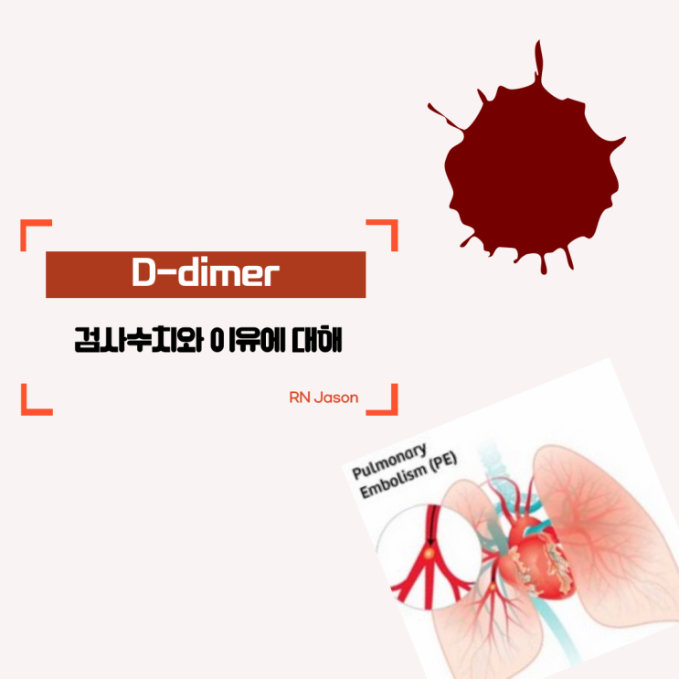  D-dimer 검사 이유와 수치가 높으면 어떻게 될까요??
