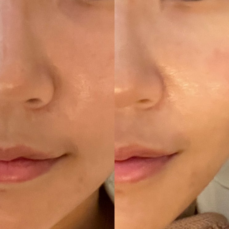  영통 피부관리 올리다 에스테틱 모공관리 멜라쎄라(인젝션) 후기: 모공 걱정 끝!