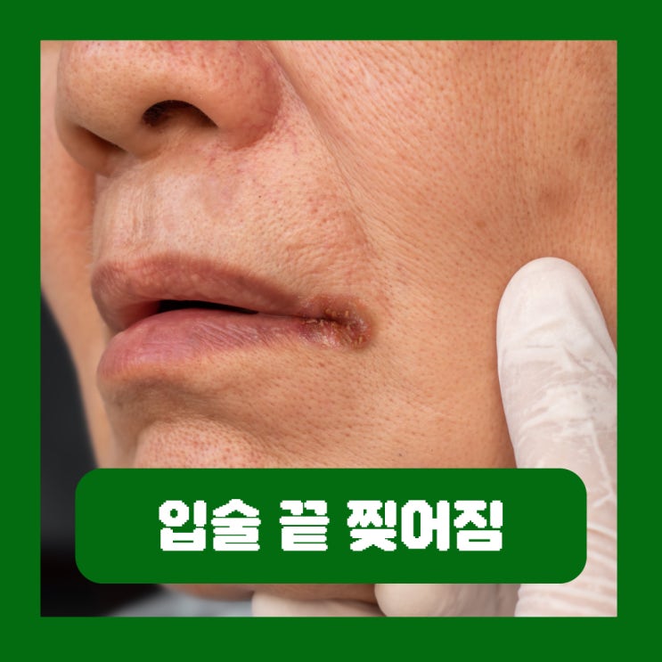  입술 끝 찢어짐 원인 구각염 아시클로버 에스로반 연고 병원 치료
