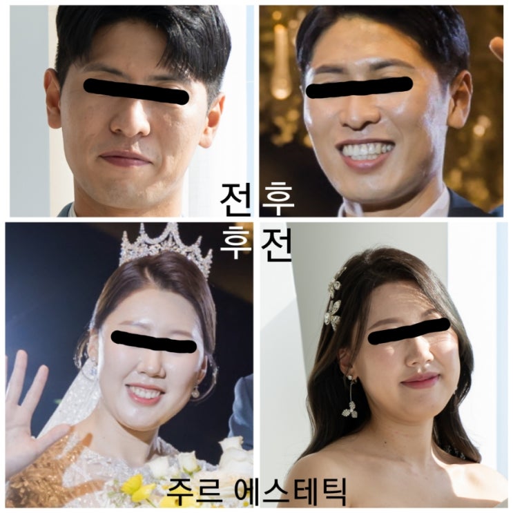  ️부산 범일동 물방울+하이푸+프락셔널 얼굴 리프팅관리️주르 에스테틱