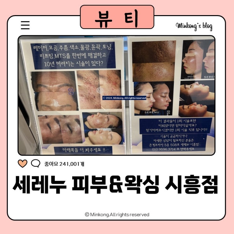  시흥리프팅 세레누 피부 & 왁싱 시흥점에서 이중턱 브이라인 한방에 해결