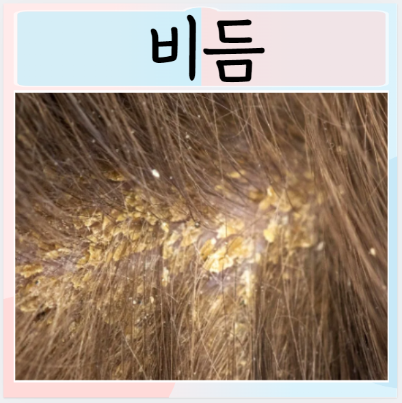  비듬 머리에 하얀가루 생기는 이유 없애는법