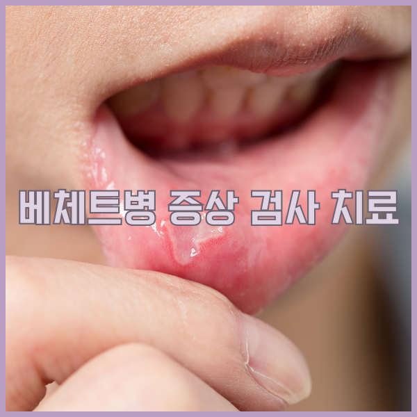 베체트병 증상 검사 치료