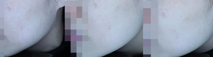  개인적으로 좋아하는 혈관 레이저 (532 long pulse)
