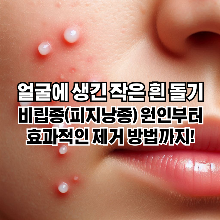  얼굴에 생긴 작은 흰 돌기, 비립종(피지낭종) 원인부터 효과적인 제거 방법까지!