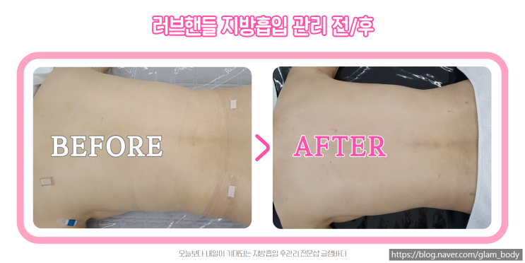  러브핸들 지방흡입 후 바이오본드 어떻게 풀어야 할까요?