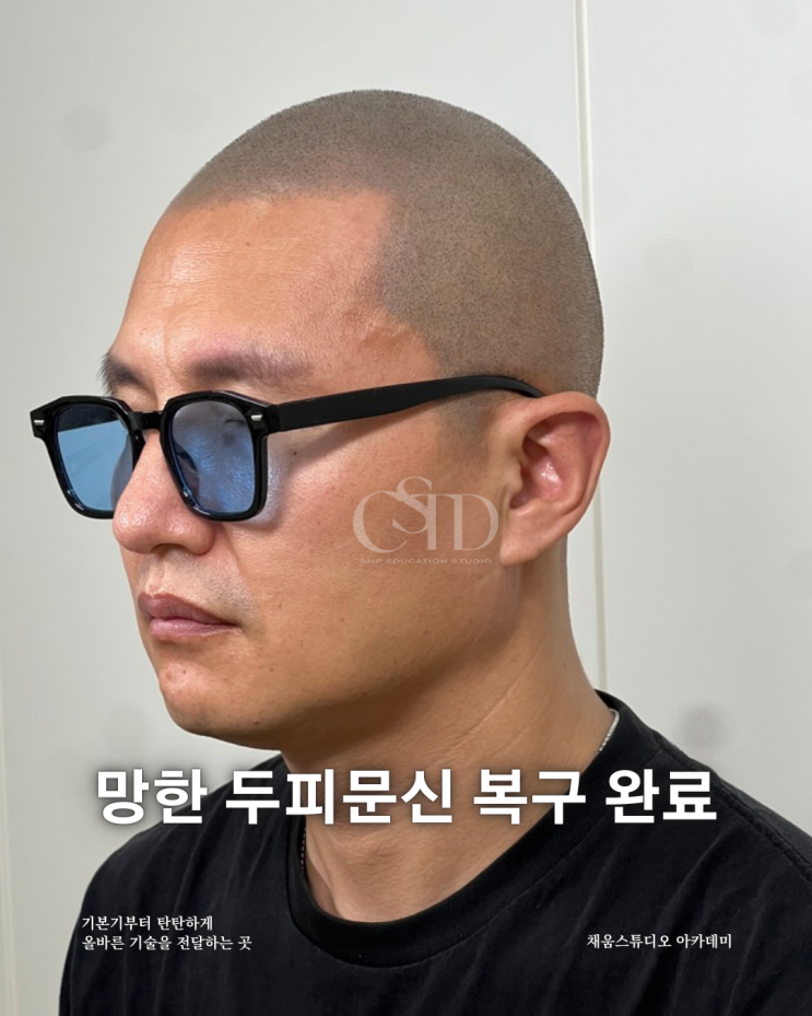  광주 두피문신 부작용 원인과 복구 방법