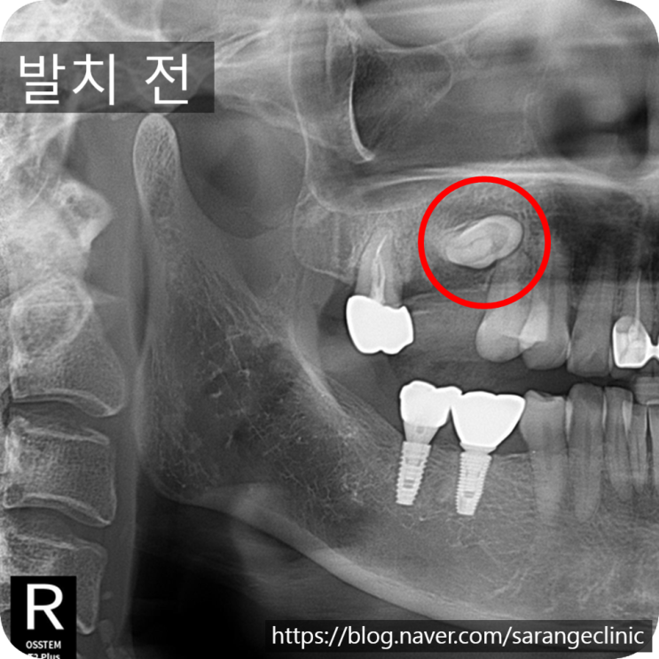  천안 신부동 완전매복 소구치 발치