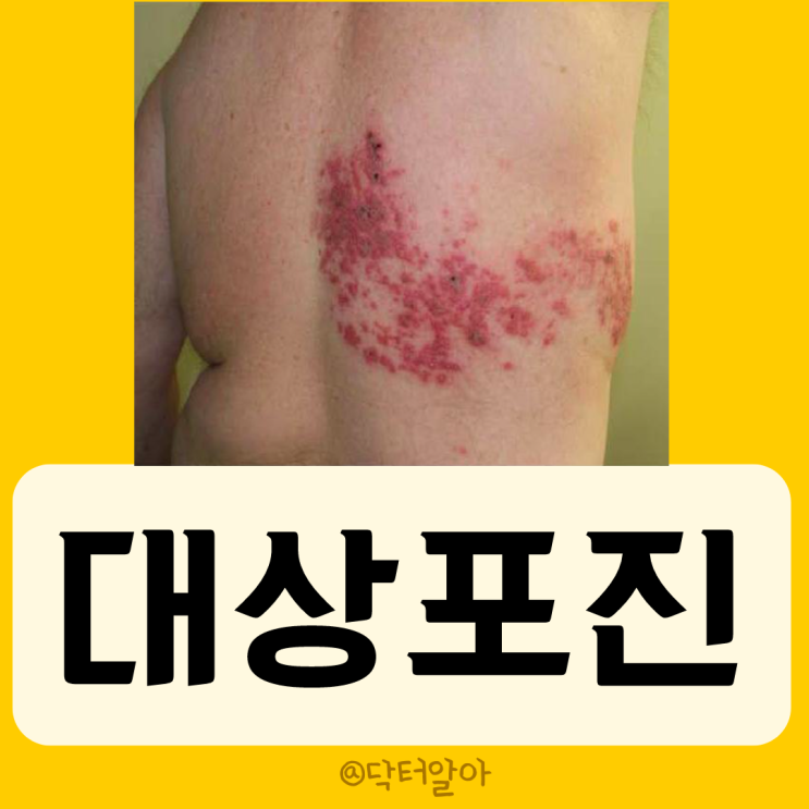  대상포진(herpes zoster)의 정의, 증상, 진단, 치료 및 예방