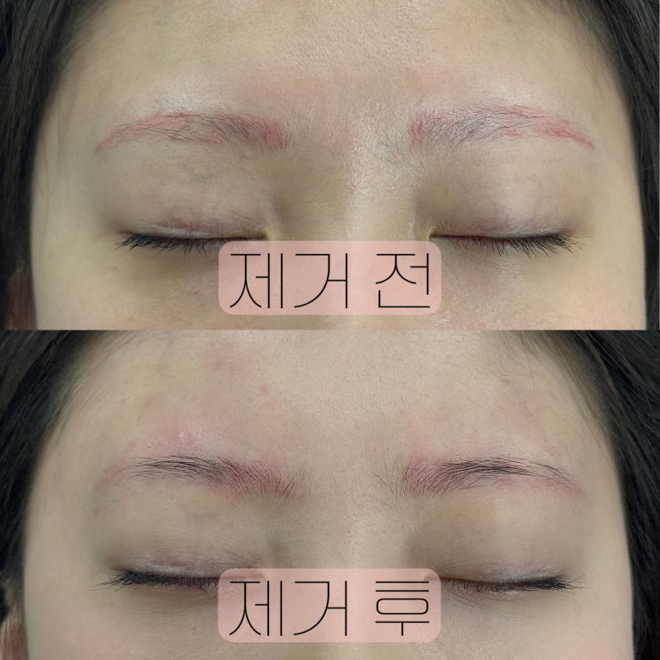 천안 눈썹문신, 잘못된눈썹 꼭 제대로 알고 지우세요! 천안 눈썹문신, 잘못된눈썹 꼭 제대로 알고 지우세요!