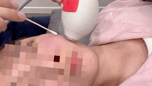  [강남역 신논현역 피부과] 얼굴 라인 정리에 좋은 튠페이스+튠라이너  받고 온 후기