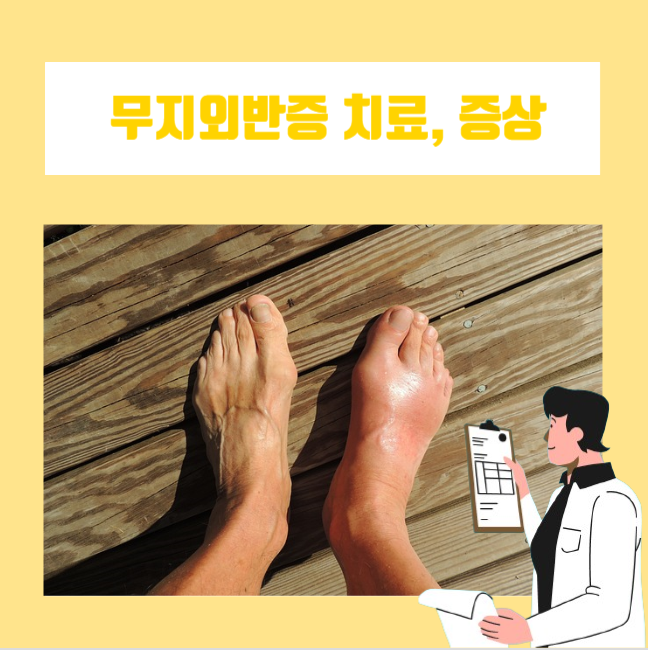  무지외반증 증상과 원인은 무엇일까? 무지외반증 치료는?