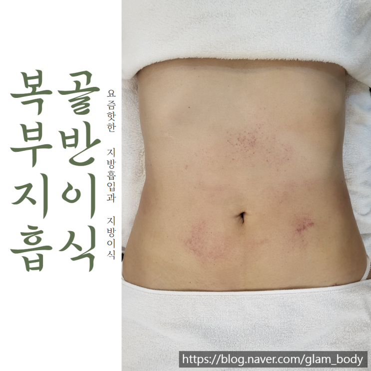  골반 지방이식을 위한 지방흡입 후관리 팁