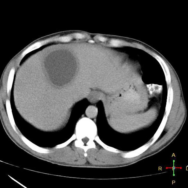  간 농양 (Liver abscess) 정의, 증상, 진단 및 치료
